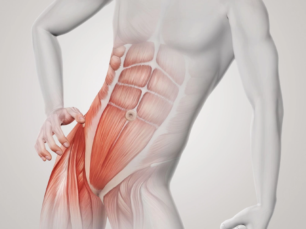 Factores de riesgo que aumentan la probabilidad de una hernia | Dr. Saúl Echeverría - Cirujano General y Laparoscópico en El Salvador